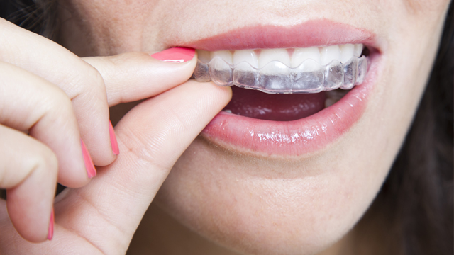 Quatre étapes pour réparer un bracket d'appareil orthodontique