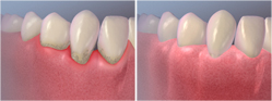 Gingival Flap Surgery